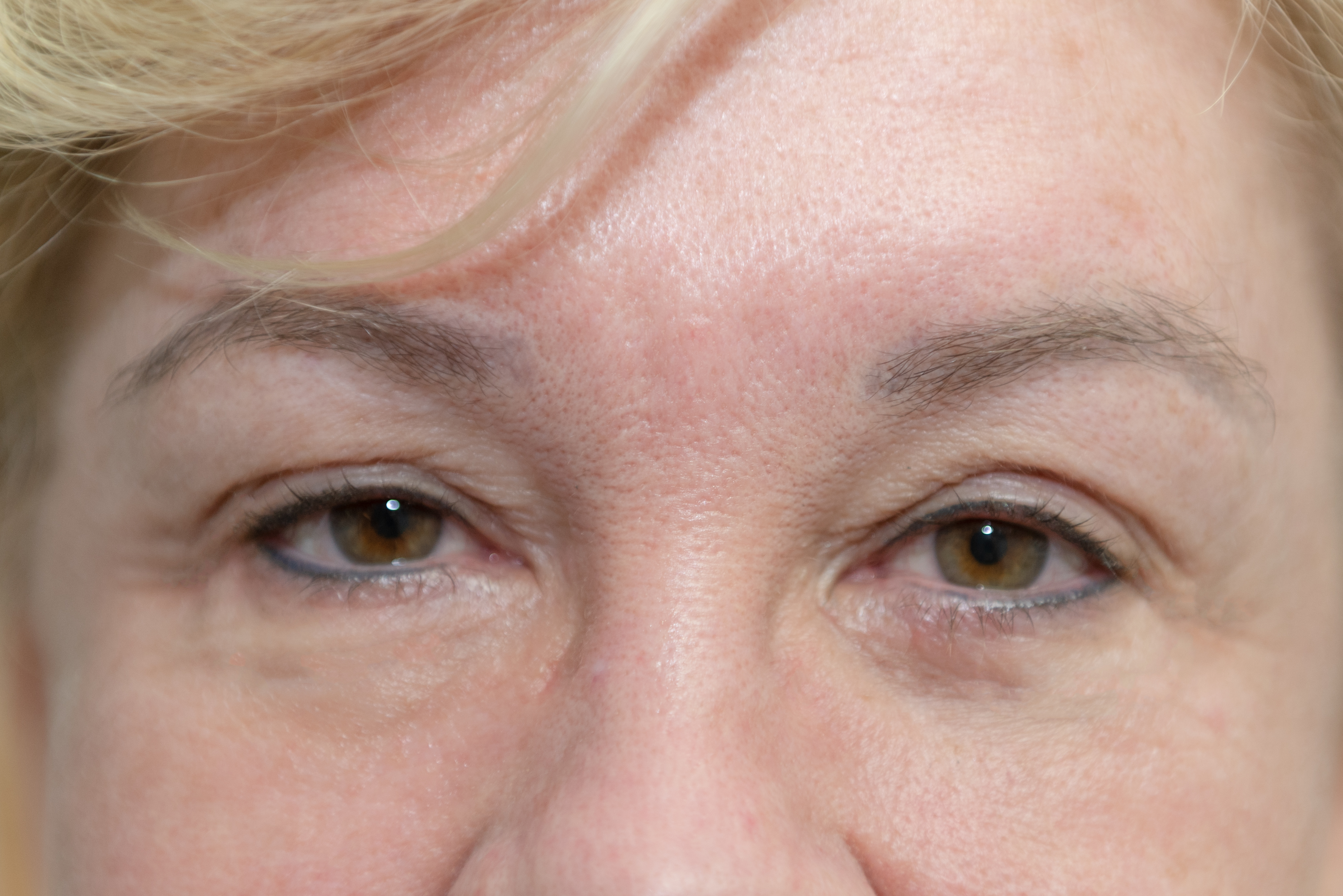 After: Tattooing inside the mucosa, (wet line) camouflages the redness and eyes look bright and healthy.