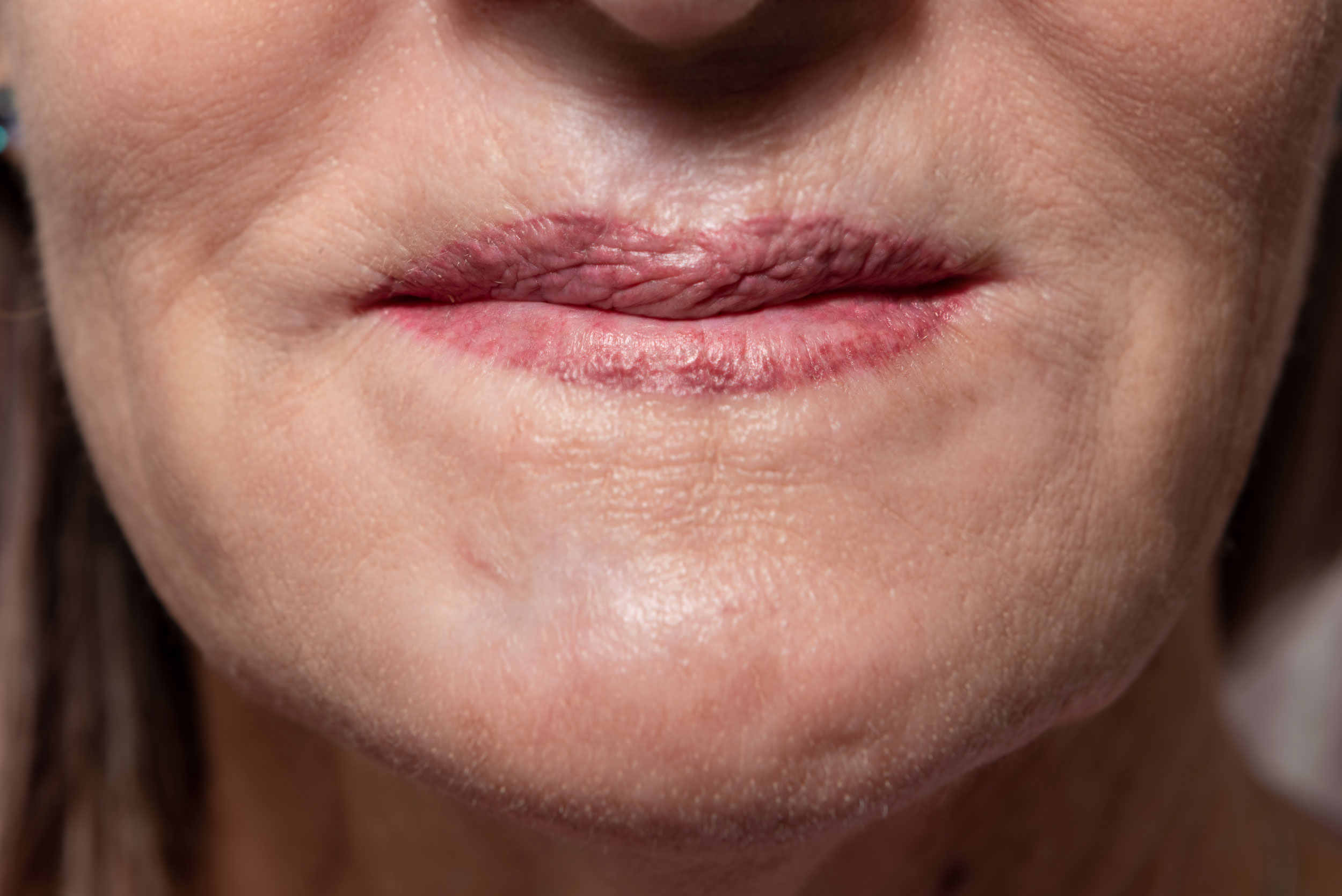 This young woman had several surgeries after a sporting accident caused severe damage to her lower face, especially her lips. The procedure took many applicatons to break through the thick scarring to create these pretty new lips. Perseverance and multiple treatments over 6 months to a year are necessary to minimze facial scarring. The face and scalp react better than the rest of the body due to the thickness, moisture and oil from the neck up.