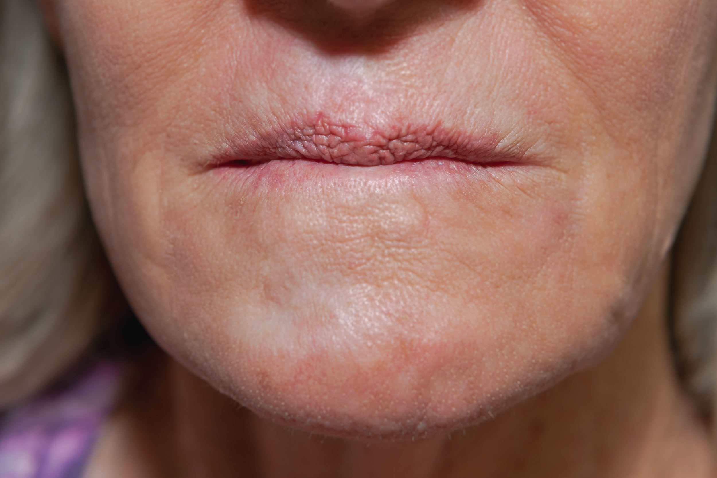 This young woman had several surgeries after a sporting accident caused severe damage to her lower face, especially her lips. The procedure took many applicatons to break through the thick scarring to create these pretty new lips. Perseverance and multiple treatments over 6 months to a year are necessary to minimze facial scarring. The face and scalp react better than the rest of the body due to the thickness, moisture and oil from the neck up.